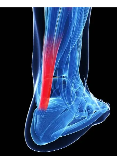 Achilles Tendinitis