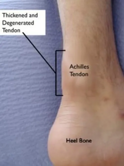 Achilles Tendinosis