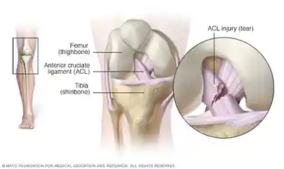 Common Knee Injuries