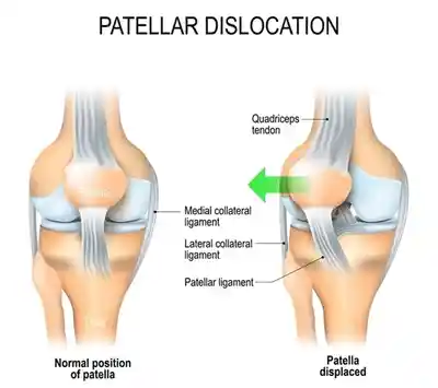 Dislocated Kneecap (Patellar Dislocation)