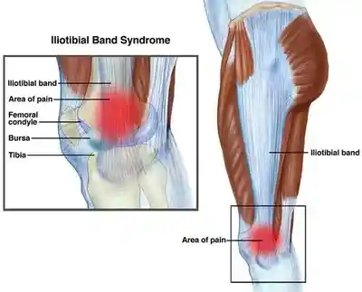 Illiotibial Band Syndrome (ITBS)