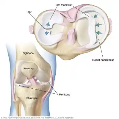 Meniscus Injury