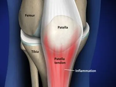 Patellar Tendonitis