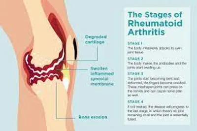 Rheumatoid Arthritis