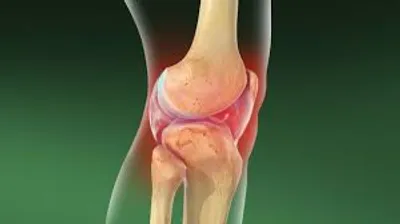 Septic Arthritis