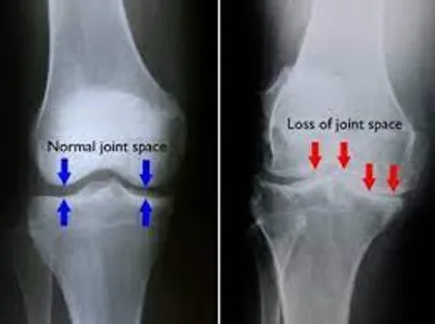 Types of Arthritis